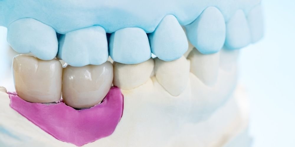 zirkonyum ve dis kaplama tedavi asamalari