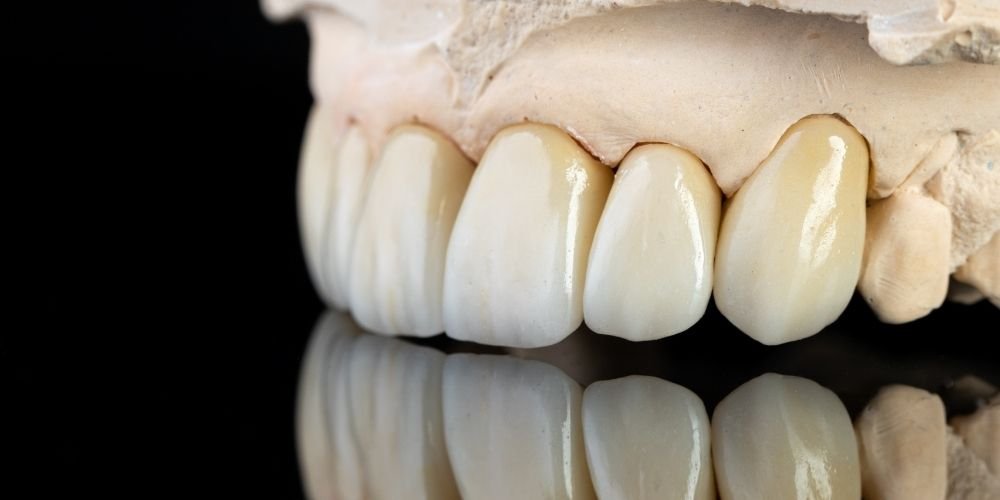 zirkonyum metal destekli ve tam seramik dis kaplama turleri