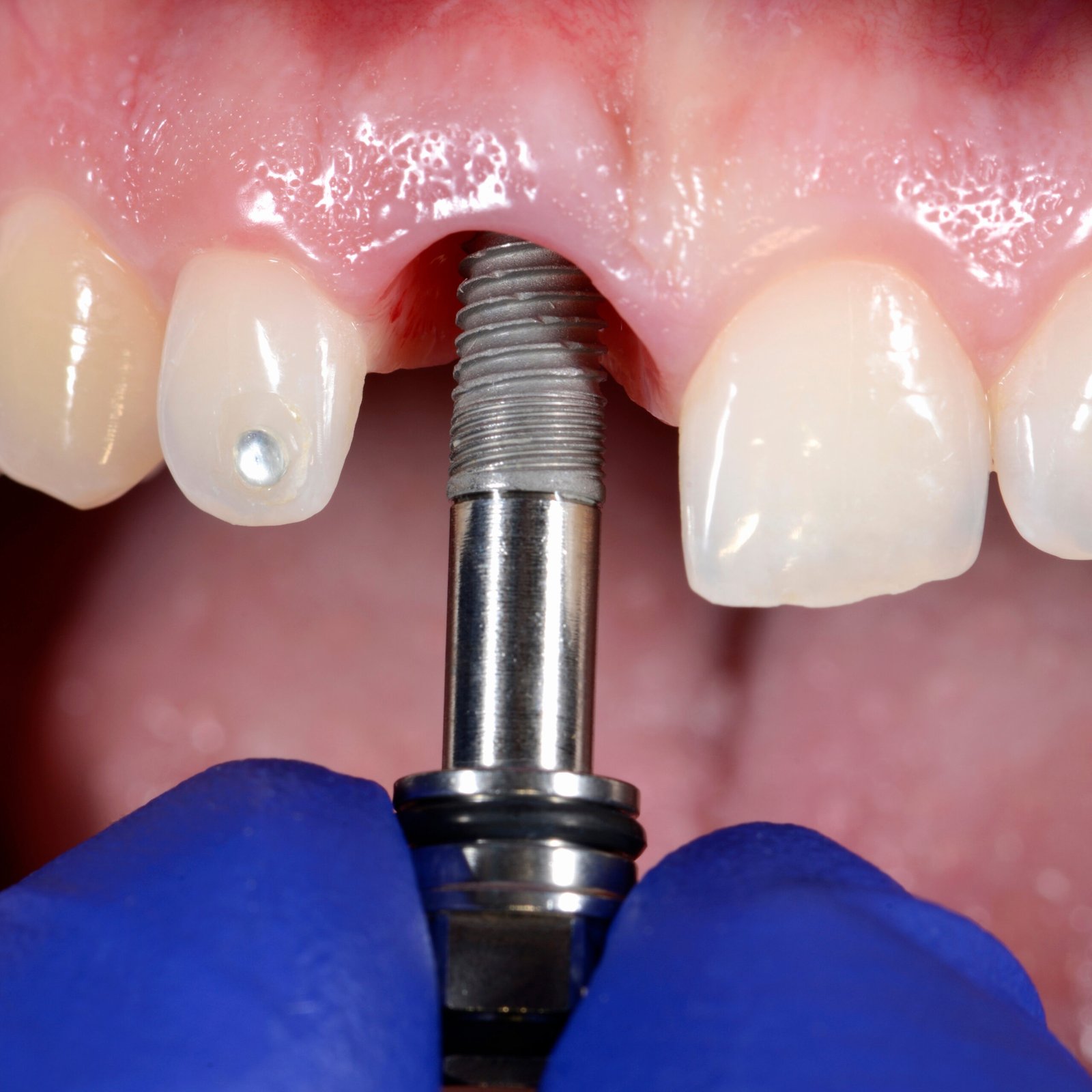 tek dis eksikligi tam dissizlik implant destekli cozumler